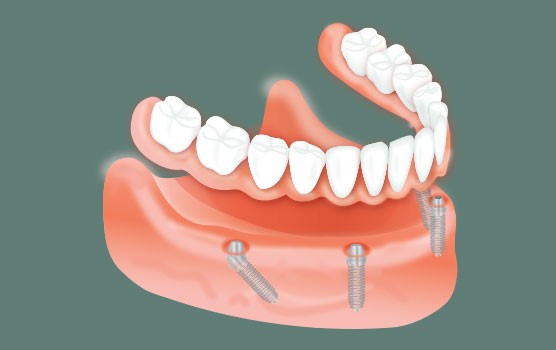 Partial Dentures For Front Teeth Bennett NC 27208